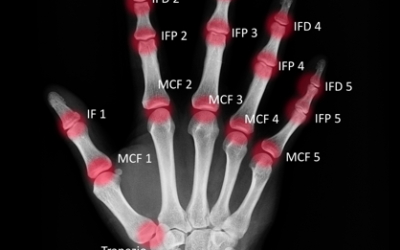 ARTRITE PSORIASICA: METODI DI VALUTAZIONE DELLA PROGRESSIONE DEL DANNO ANATOMICO IN RADIOLOGIA CONVENZIONALE