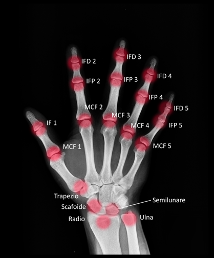 ARTRITE PSORIASICA: METODI DI VALUTAZIONE DELLA PROGRESSIONE DEL DANNO ANATOMICO IN RADIOLOGIA CONVENZIONALE