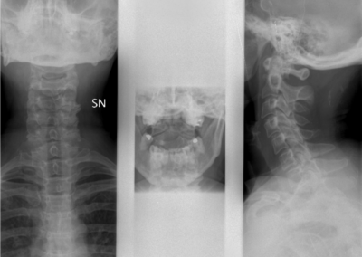 L’esame radiografico eseguito in proiezione antero-posteriore (a), con la proiezione transorale (b) e con proiezione latero-laterale (c) mostra alterazione osteostrutturale di tipo erosivo a carico del dente dell’epistrofeo e a livello delle faccette articolari di sinistra C1-C2, con associata marcata riduzione della rima articolare