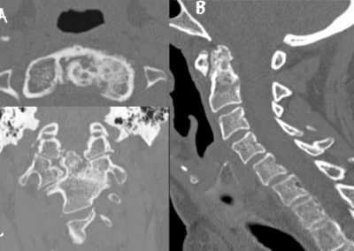 L’esame TC del rachide cervicale mostra, sia nell’acquisizione in assiale, che nelle ricostruzioni MPR sul piano sagittale (b) e coronale (c), multiple erosioni a livello del dente dell’epistrofeo ed a carico delle faccette articolari di sinistra C1-C2, con associata marcata riduzione della rima articolare e modesto disallineamento articolare, come per sublussazione. Minima irregolarità delle superfici articolari sono evidenti anche a livello di C1-C2 a destra, in particolare sul versante mediale.