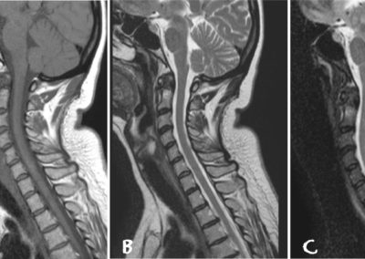 Edema intraspongioso e multiple erosioni a livello del dente dell'epistrofeo, che appare circondato da tessuto eterogeneo, in relazione a panno sinoviale, che, tuttavia, non determina significativa compressione sull'asse meningo-midollare. Canale rachideo di ampiezza nei limiti della norma