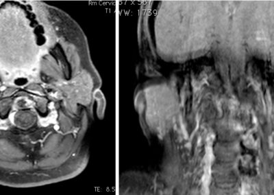 . Le sequenze T1 fat sat dopo mdc mostrano multiple erosioni a livello del dente dell'epistrofeo, circondato da tessuto eterogeneo, che presenta intenso enhancement contrastografico, in relazione a panno sinoviale attivo. Erosioni delle faccette articolari di sinistra C1-C2, associate a modesto disallineamento articolare come per sublussazione, enhancement contrastografico intraspongioso delle masse laterali, soprattutto di C2, in relazione ad osteite.