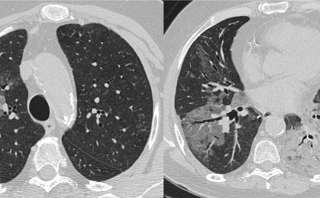 POLMONITE LIPOIDEA IN ARTRITE REUMATOIDE