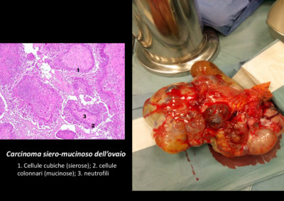 Intervento chirurgico di isterectomia totale extra- fasciale, annessiectomia bilaterale, omentectomia totale e asportazione di linfonodi pelvici per cistoadenocarcinoma sieroso (stadio III della classificazione FIGO).