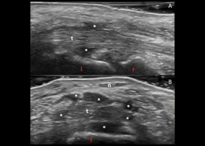 ECOGRAFIA:  La scansione longitudinale (A) e trasversa (B) della regione palmare della mano destra mostra ispessimento ipo-anecogeno dei tessuti molli limitrofi alla guaina dei tendini flessori delle dita a livello carpale (asterischi bianchi) , non compressibile, compatibile con tessuto fibrotico r = radio; l = semilunare, t = tendini flessori delle dita,  n = nervo mediano.