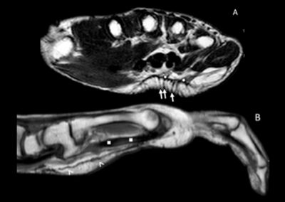 ECOGRAFIA:  La scansione longitudinale (A) e trasversa (B) della regione palmare della mano destra mostra ispessimento ipo-anecogeno dei tessuti molli limitrofi alla guaina dei tendini flessori delle dita a livello carpale (asterischi bianchi) , non compressibile, compatibile con tessuto fibrotico r = radio; l = semilunare, t = tendini flessori delle dita,  n = nervo mediano.