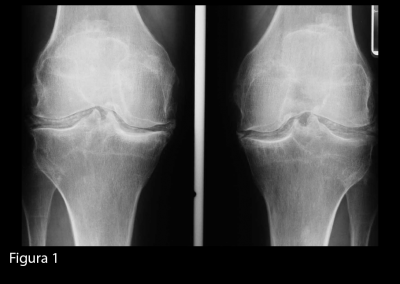 Radiografia delle ginocchia in proiezione antero-posteriore. Si evidenziano calcificazioni meniscali, bilateralmente.