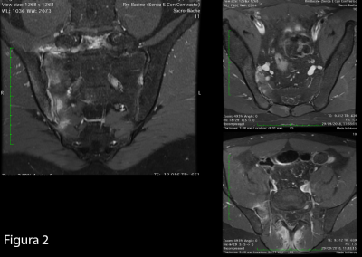 Le sequenze T1 fat sat con mdc in sezione paracoronale (a) e paassiale (b,c)  mostrano enhancement contrastografico nelle stesse sedi ove era apprezzabile l’alterazione di segnale di tipo edematoso,  a carico dell’articolazione sacro-iliaca destra, compatibile con osteite, con interessamento dei tessuti molli limitrofi, ed in particolare al muscolo ileo-psoas a destra e i muscoli paravertebrali. Si associano segni di sinovite, entesite e capsulite a carico dell’articolazione sacro-iliaca destra.