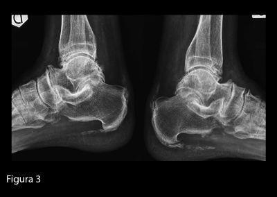 Radiografia delle caviglie in proiezione latero-laterale. Diffuse calcificazioni a livello delle entesi, delle articolazione intertarsiche e della articolazione tibio-peroneo-astragalica, bilateralmente.