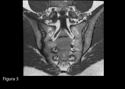 La sequenza morfologica T1 pesata in sezione paracoronale mostra irregolarità dei capi articolari dell’articolazione sacro-iliaca destra, con aspetti  erosivi e pseudoallargamento della rima articolare, in relazione a sacroileite cronica