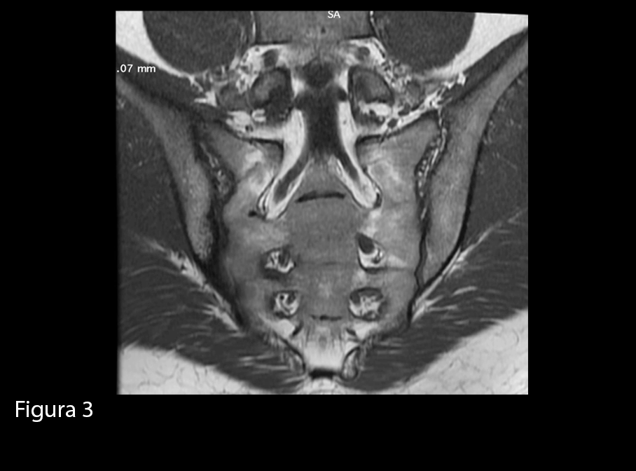 GLUTEALGIA IN SPONDILOARTRITE