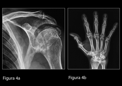 (a) Radiografia convenzionale della spalla sinistra in proiezione antero-posteriore. Si evidenziano diffuse calcificazioni a livello dei tessuti molli periarticolari e scapolo-omerali dell’articolazione scapolo-omerale.  (b) Radiografia convenzionale della mano destra. Si osservano calcificazioni del legamento triangolare del carpo e dei tessuti molli a livello delle articolazioni metacarpo-falangee ed inter-falangee prossimali