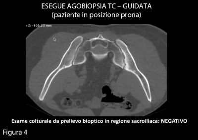 La TC eseguita per la guida bioptica conferma gli aspetti erosivi a carico dei capi articolari dell’articolazione sacro-iliaca destra, con pseudoallargamento della rima articolare e modesta sclerosi subcondrale sul versante iliaco, in relazione a floigosi cronica.