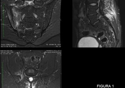 Le sequenze  STIR in sezione paracoronale, paraassiale (b) e sagittale (c) mostrano  alterazione di segnale di tipo edematoso a carico dei capi articolari dell’articolazione sacro-iliaca destra, compatibile con sacroilite attiva, con versamento articolare omolaterale. L’edema interessa la capsula articolare in sede anteriore e si estende ai tessuti molli limitrofi ed in particolare al muscolo ileo-psoas, ai muscoli paraveterbrali e ai tessuti molli superficiali in sede posteriore. Si associa edema delle faccette articolari, con segni di sinovite interapofisaria nel  tratto lombare distale.