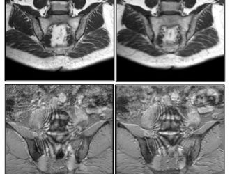 ARTRITE PSORIASICA: SEMEIOTICA DELLE LESIONI ELEMENTARI IN RISONANZA MAGNETICA