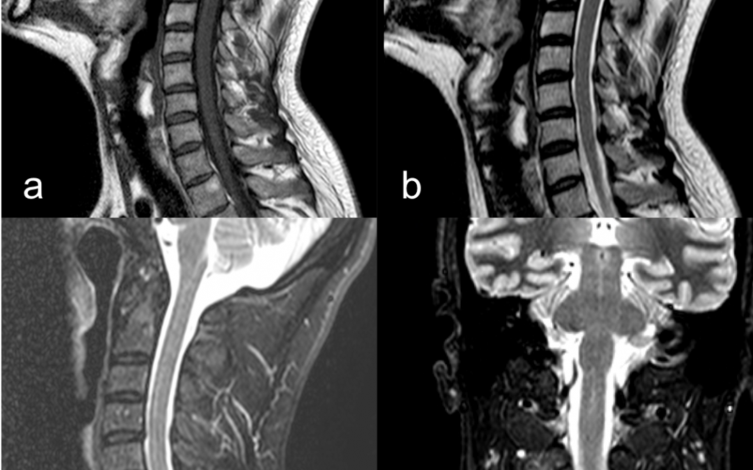 SPONDILOARTRITE PSORIASICA: COINVOLGIMENTO CERVICALE