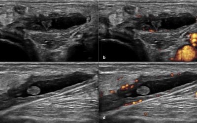 UTILITÀ CLINICA E POTENZIALITÀ DELL’ECOGRAFIA NELL’OSTEOARTROSI