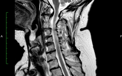 L’IMAGING DELLE SINDROMI DOLOROSE DEL RACHIDE CERVICALE