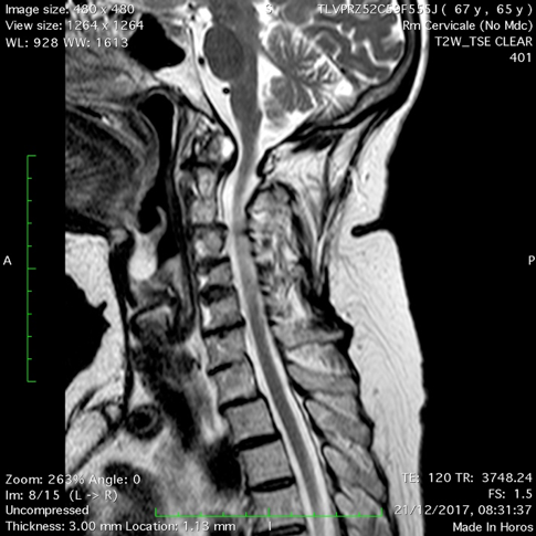 L’IMAGING DELLE SINDROMI DOLOROSE DEL RACHIDE CERVICALE