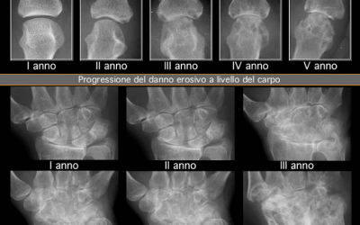 ARTRITE REUMATOIDE: METODI DI VALUTAZIONE DELLA PROGRESSIONE DEL DANNO ANATOMICO IN RADIOLOGIA CONVENZIONALE