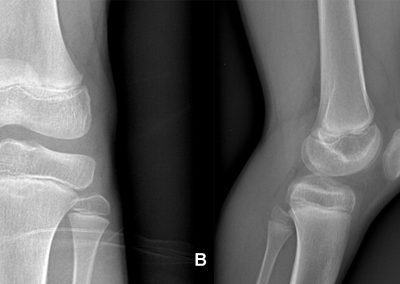 Figura 1. A, B: L’esame biproiettivo del ginocchio sinistro non mostra evidenti lesioni osteostrutturali con ipodiafania del recesso sottoquadricipitale, in relazione a versamento