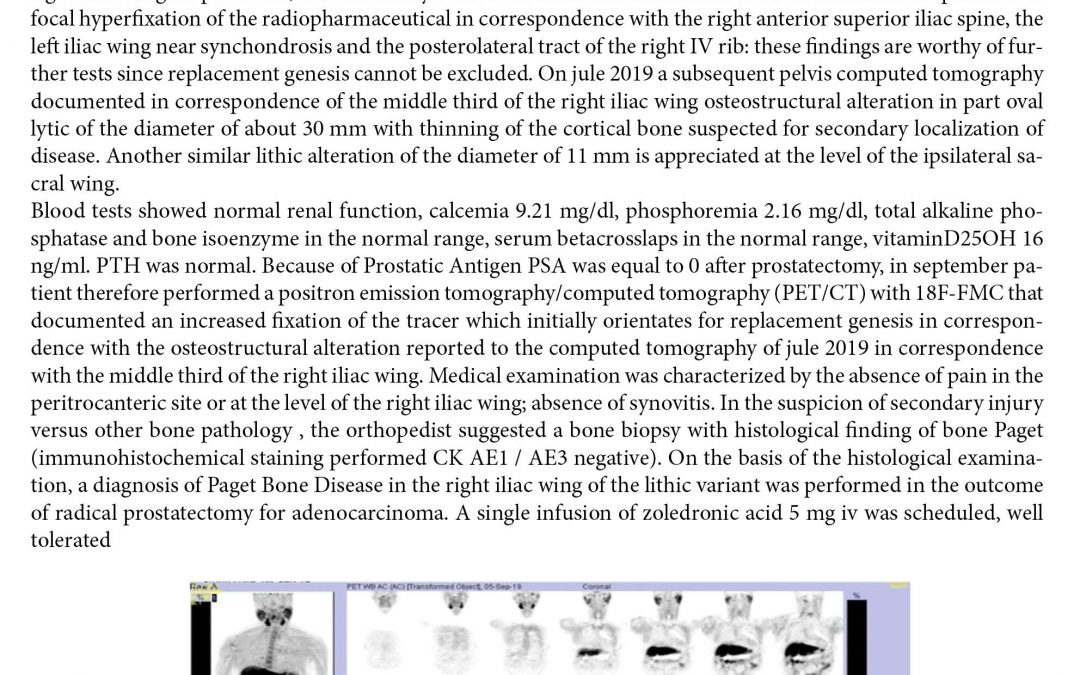 Paget bone disease demonstrated on 18F fluorocholine PET/CT: A case report