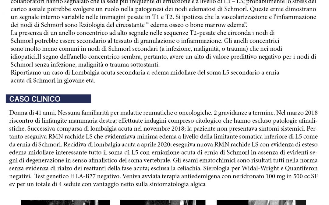 Lombalgia acuta: caso atipico di edema osseo in ernia di Schmorl acuta