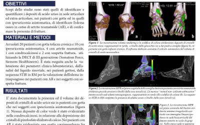 Utilità della TC dual energy (DECT) nello studio dell’apparato muscolo-scheletrico: caratterizzazione e quantificazione dei cristalli di urato monosodico, dell’edema osseo intraspongioso nell’artrite reumatoide e nelle sospette fratture