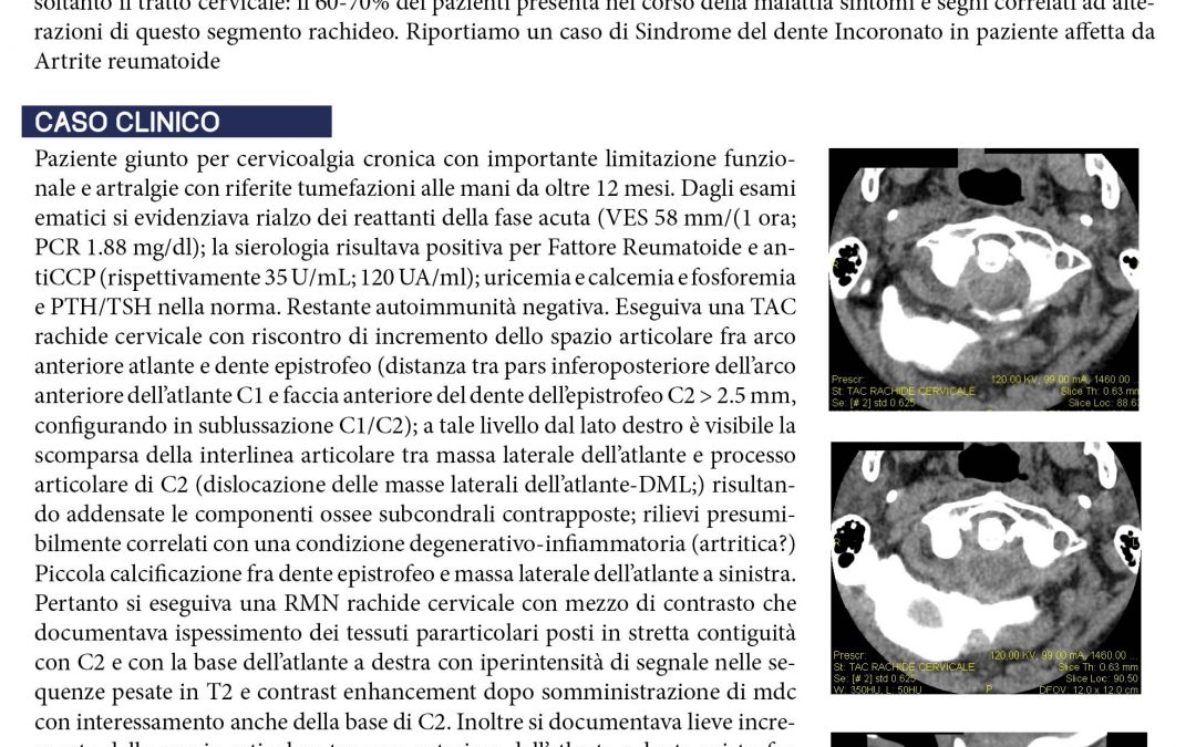 Cervicalgia: non solo spondilouncodiscoartrosi. Sindrome del dente incoronato in paziente con artrite reumatoide