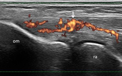 L’ENTESITE NELLE SPONDILOARTRITI SIERONEGATIVE: L’IMAGING ECOGRAFICO