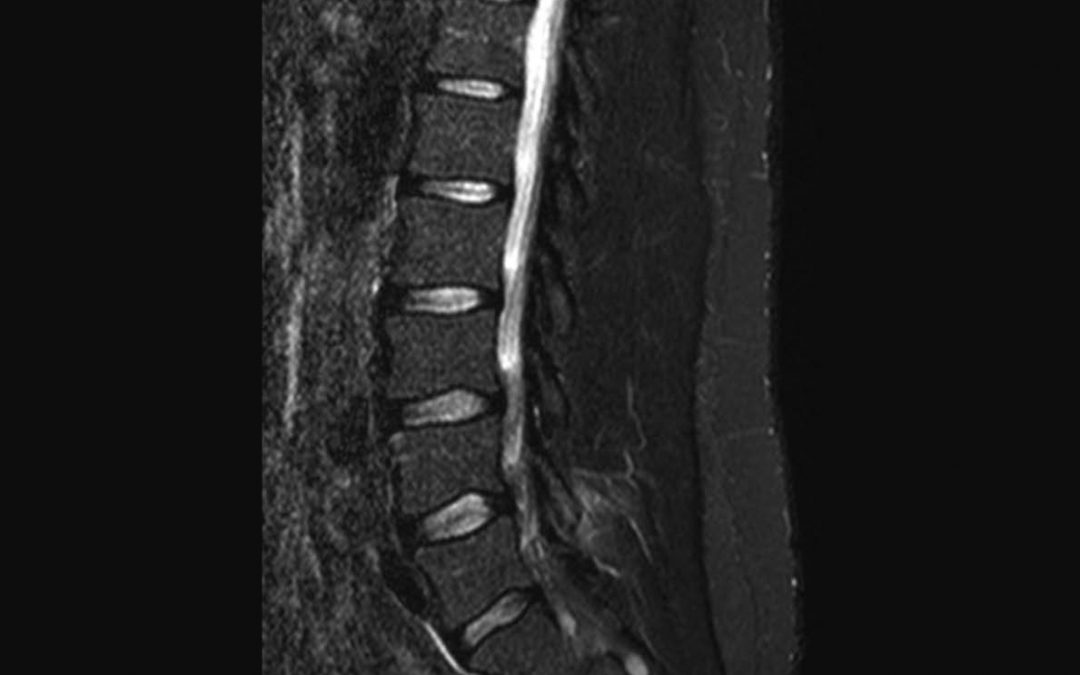 SPONDILOARTRITE ASSIALE: SEMEIOTICA DELLE LESIONI ELEMENTARI IN RISONANZA MAGNETICA