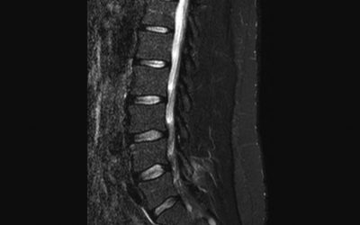 SPONDILOARTRITE ASSIALE: SEMEIOTICA DELLE LESIONI ELEMENTARI IN RISONANZA MAGNETICA