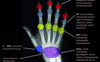 IMAGING DELLE SINDROMI DOLOROSE DELLA MANO E DEL POLSO