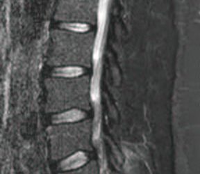 SPONDILODISCITI INFIAMMATORIE NON INFETTIVE ED INFETTIVE: DIAGNOSTICA DIFFERENZIALE E RUOLO DELLA RISONANZA MAGNETICA 